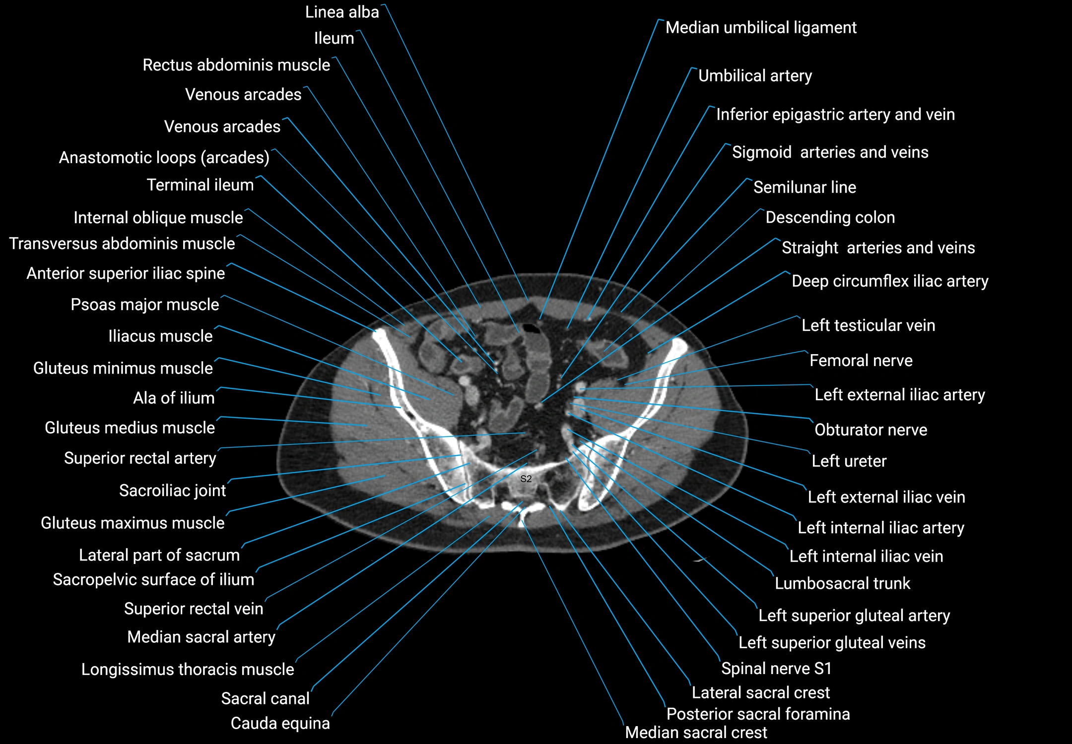 CT male pelvis axial cross sectional anatomy labelled radiology image -00154.webp